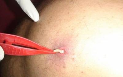 في مشهد لا يصدقه العقل...استخراج دودة حية من كتف مريض.!!!. وسط حيرة الأطباء  صورة 