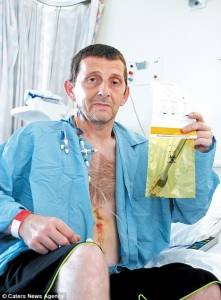 المريض لم يعلم بوجود شوكة في معدته منذ 10 سنوات