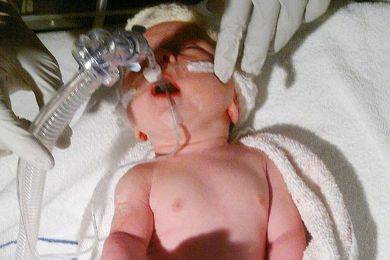 الطفلة المعجزة تنمو بلا رئة وكلية.. وقلب على اليمين