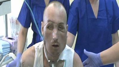 عدم مشاهدتها لأصحاب القلوب الضعيفة.. أول عملية زراعة وجه لمواطن بولندي   فيديو وصور