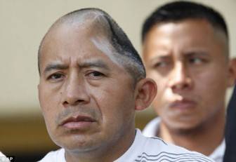 58 مليون دولار تعويض لرجل فقد ربع راسه