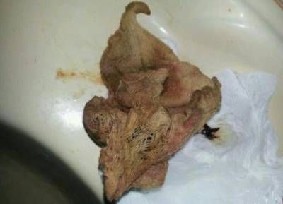 بالصورة... نسيان شاش طوله متر برحم سيدة بمستشفى حكومي بالسعودية