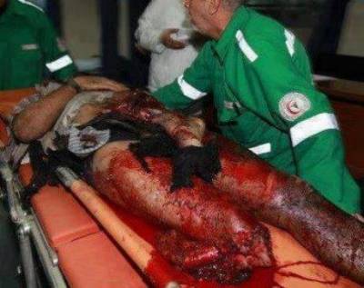 بتر ساق المصور خضر الزهار بعد استهداف الأحتلال لمركز اذاعة القدس