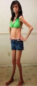 بالفيديو والصور..أنحف امرأة فى العالم..تزن 25 كيلو وتأكل 60 وجبة يوميا