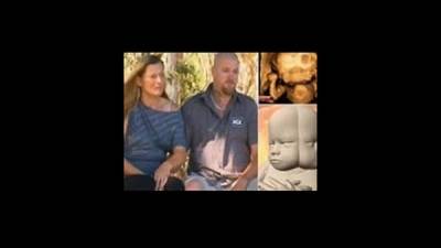 زوجان يقرران الاحتفاظ بجنين بوجهين ملتصقين في جسم واحد