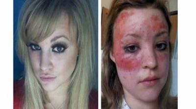 برغم تشوه وجها فتاة  تخوض مسابقة جمال.. صور