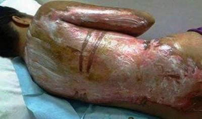 فيديو وصورة .. احرقوا خادمتهم بالماء المغلي لانها أردت أكل بقايا الطعام فقط..!