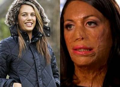 بالصور.. 10 ملايين دولار تعويضًا لعارضة أزياء احترق 64 من جسدها