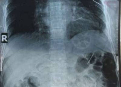 بالصور.. أطباء يعثرون على 9 دبابيس بالرئة والكلى والكبد لسيدة غرزها زوجها بجسمها