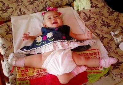 طفلة تعيش بثلاث أرجل بعد فصلها عن توأمها الملتصق