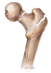 محاضرة طبية عن هشاشة العظام في عجلون