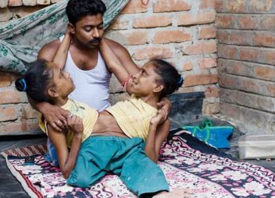 بالصور.. توأم ملتصق تقعان في حب رجل واحد