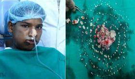 أطباء يقتلعون 232 سناً من فم هندي بعمر 17 عاماً