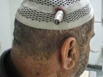 صور: قصة العراقي الذي فشل الرصاص باختراق رأسه