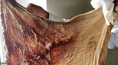 قطعة قماش في احشاء سيدة سعودية ..