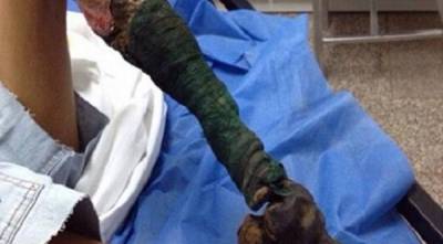 ساق مراهقة تتحول الى (قطعة فحم)