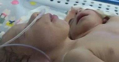 مصرية تضع طفلاً برأسين وقلبين وثلاثة أذرع