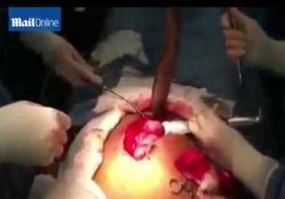 استخراج سمكة ضخمة حية من أمعاء برازيلي.. فيديو