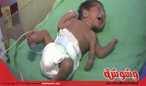 فيديو | ولادة طفل بثلاثة أذرع نتيجة حالة مرضية نادرة تسمى “كثرة الأطراف”