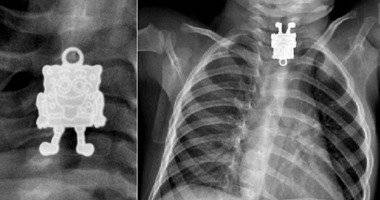 بالصور.. رضيع يعانى ألمًا بالمعدة.. والأشعة: الطفل مصاب بـسبونج بوب