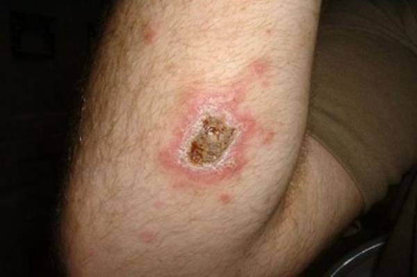 صحيفة بريطانية :مرض جلدي نادر سيعجل بنهاية (داعش)