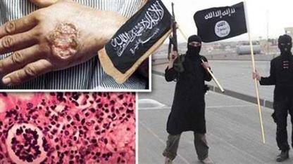 بالتفاصيل...الكشف عن سبب الوباء الجلدي الذي يفتك بتنظيم «داعش» الإرهابي!