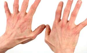 علاج الصدفية خلال 12 أسبوعا