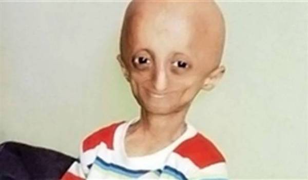 بالصور.. هندي لم يبلغ الـ 14 ومصاب بـ شيخوخة مبكرة