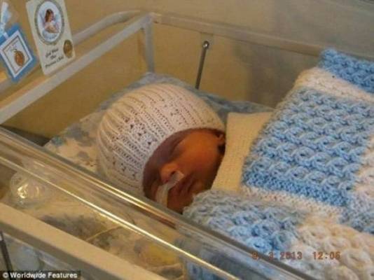 بالصور حالة حيرت الاطباء.. طفل يولد بدون دماغ