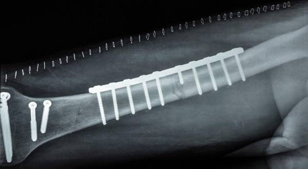 ألمانيا.. ابتكار طريقة تعالج الكسور باستخدام شريحة إلكترونية