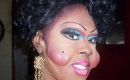 بالصور شاهد.. تشوهات مرعبة لمشاهير و نجوم ... والسبب !