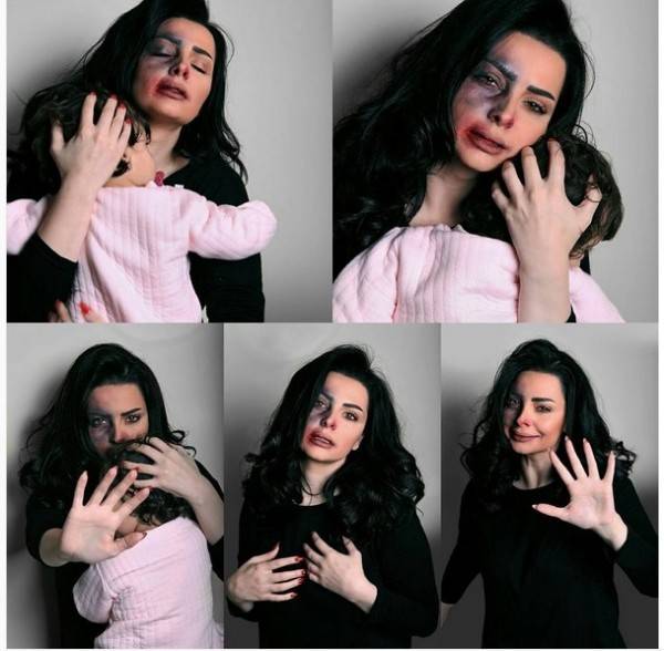 آثار تعنيف على وجه ديانا كرزون