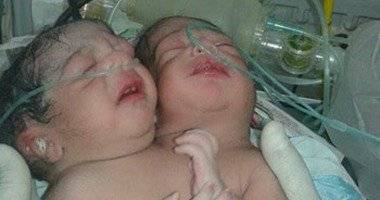 حالة نادرة لم ترد فى تاريخ الطب سوى خمس مرات.. الأب: نفسى ولو بنت واحدة منهما تعيش.