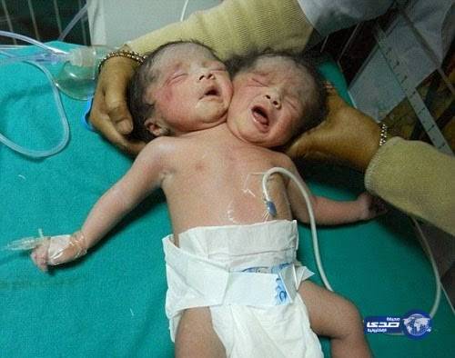 طفل برأسين يتحدى الأطباء لمدة 30 ساعة !!