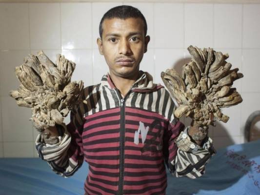بالصور  مرض غريب يحول جلد هذا الرجل إلى خشب ولحاء شجر