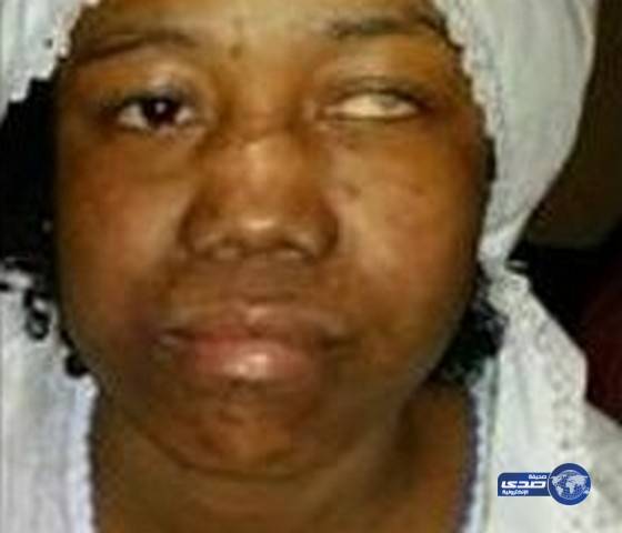 افقدتها عينها ..الحكم على طبيبة بالسجن لمدة 3 سنوات لتعذيبها خادمتها