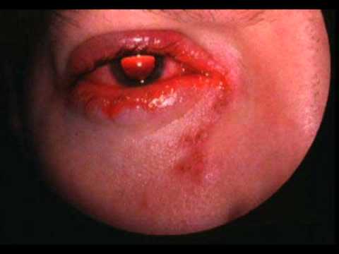 فتاة 19 عاما تنشر الإيدز متعمدة وسط الشباب من خلال العلاقات الجنسية