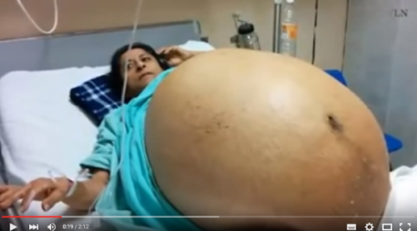 لن تصدق بالفيديو.. إمرأة تزن أكثر من 275 كيلو.. شاهد ماذا وجدوا داخل جسمها!