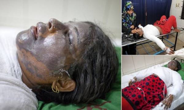 العريس احرق العروس لان المهر الذي قدمته له كان قليلا .. صور