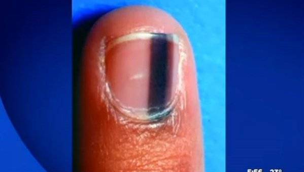 إذا فاجأتكم نقطة سوداء على ظفركم أسرعوا إلى المستشفى!