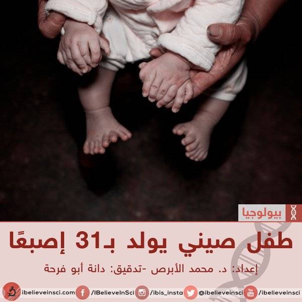 طفل صيني يولد ب31 إصبعًا شرح الحالة و أسبابها