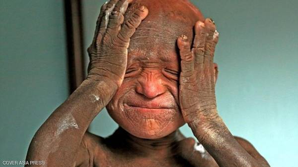 بسبب مرض نادر.. طفل يتحول إلى تمثال حجري