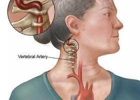 لماذا تصاب النساء بالسكتة الدماغية أكثر من الرجال؟
