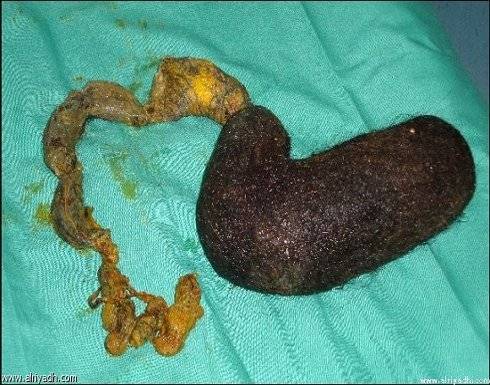 استخراج «كتلة شعر» تزن 1300 جرام من بطن فتاة