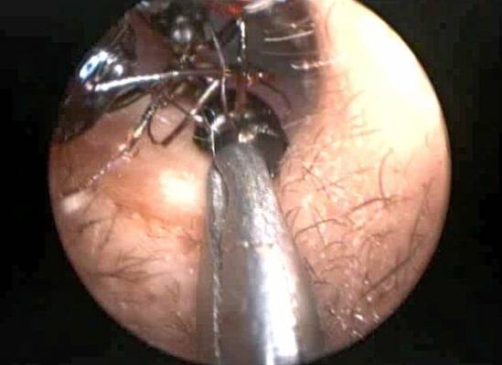 الأطباء يعجزون عن حل لغز استيطان ألف نملة في أذن طفلة هندية