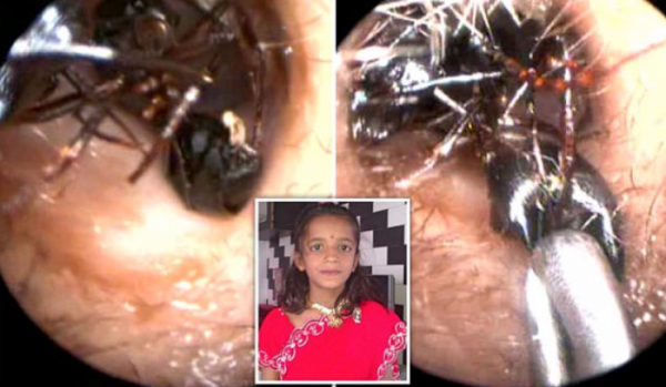 كانت تشكو من ألم في أذنها .. عندما اكتشف الاطباء السبب أصيبوا بالصدمة!!