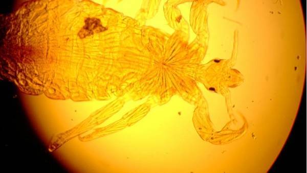 أطباء أمريكا قلقون من انتشار قمل الرأس