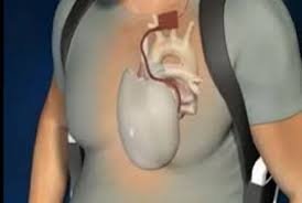 بيحمل قلبه خلف ظهره.. كيف يعيش ... شاهد الفيديو