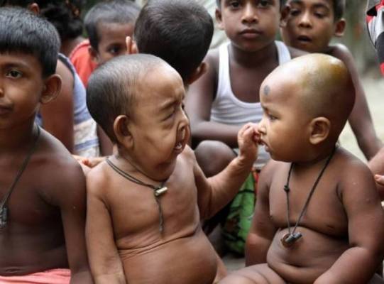 بالصور.. الطفل المسنّ الذي حيّر العالم