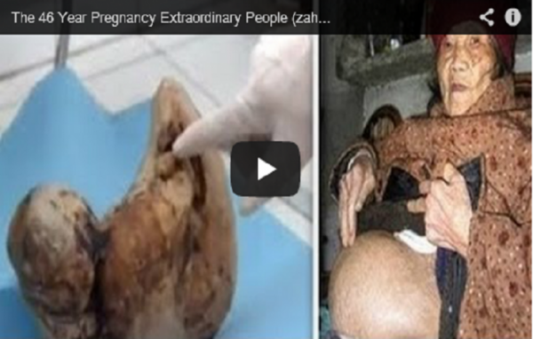 ظلَّ الورم يكبر لمدة 46 عاماً في بطن هذه العجوز.. إلى ان اكتشفوا الكارثة المخيفة  فيديو